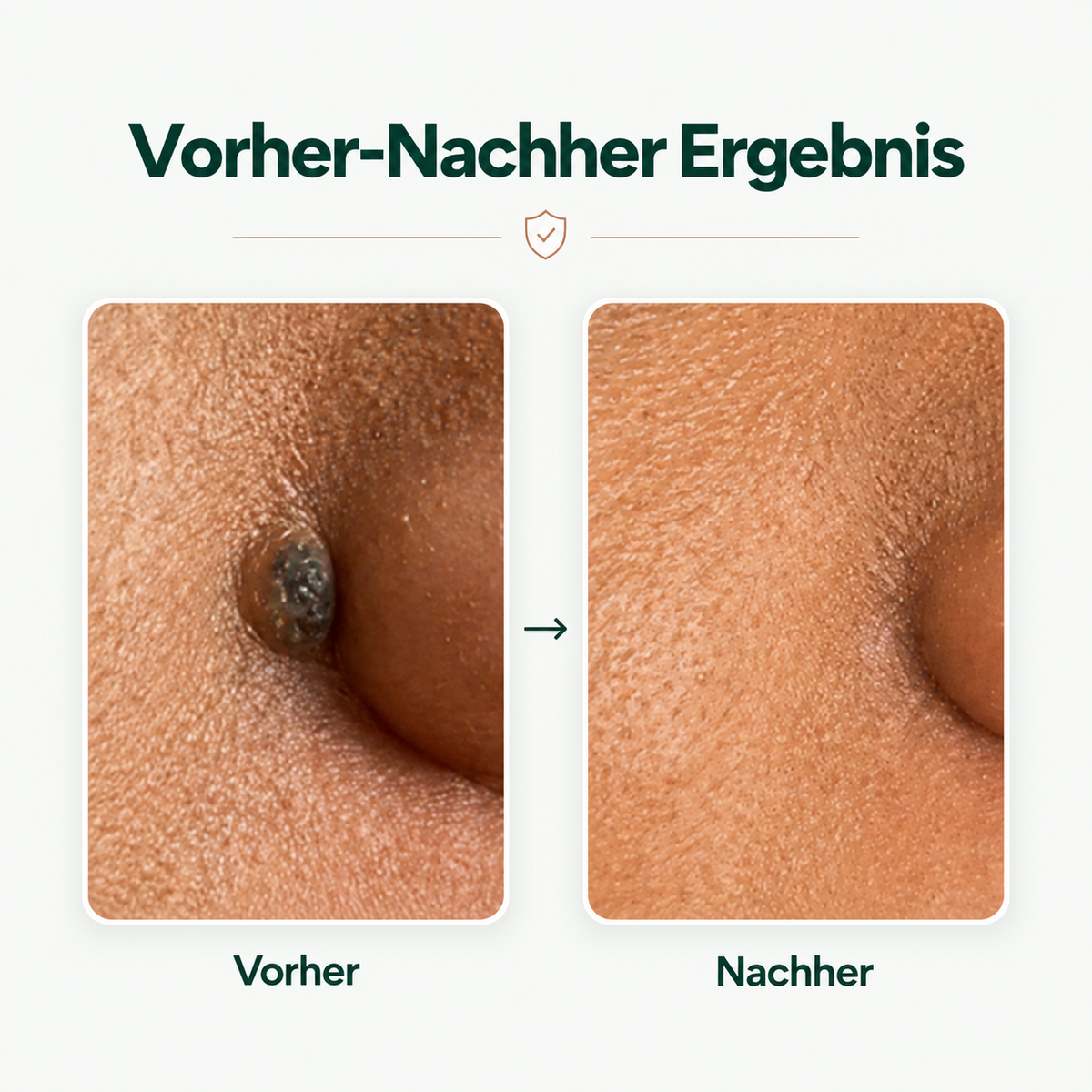 Creamole – Pflanzliche Creme zur Entfernung von Muttermalen, Leberflecken & Warzen