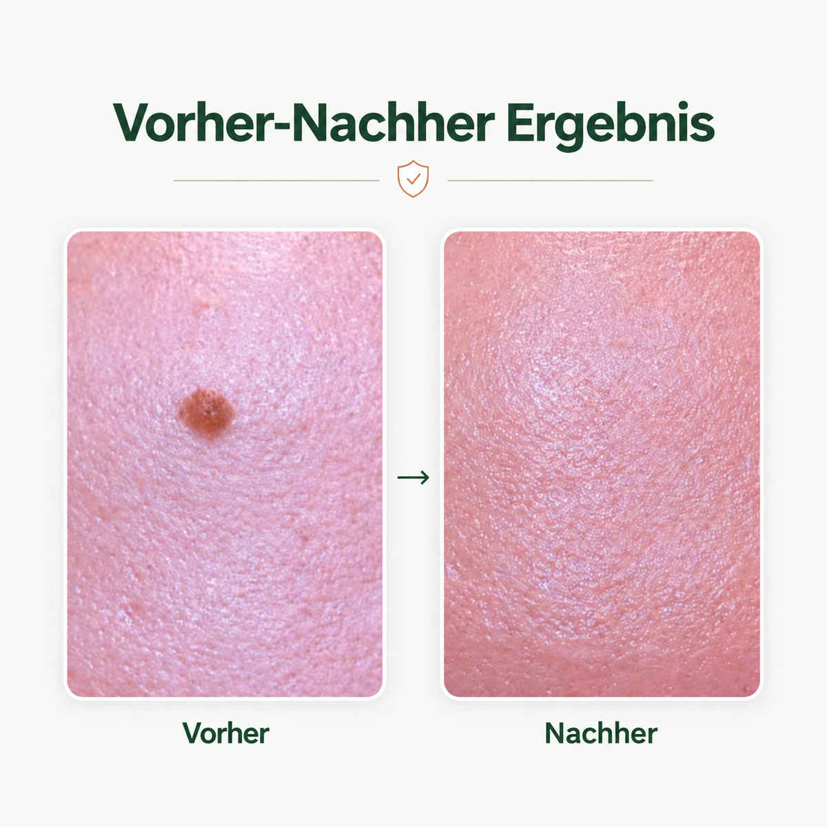 Creamole – Pflanzliche Creme zur Entfernung von Muttermalen, Leberflecken & Warzen