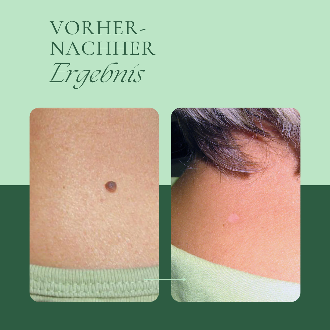 Creamole - Pflanzliche Creme zur Entfernung von Muttermalen, Leberflecken & Warzen