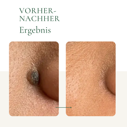 Creamole - Natürliche Creme zur Entfernung von Muttermalen, Leberflecken & Warzen