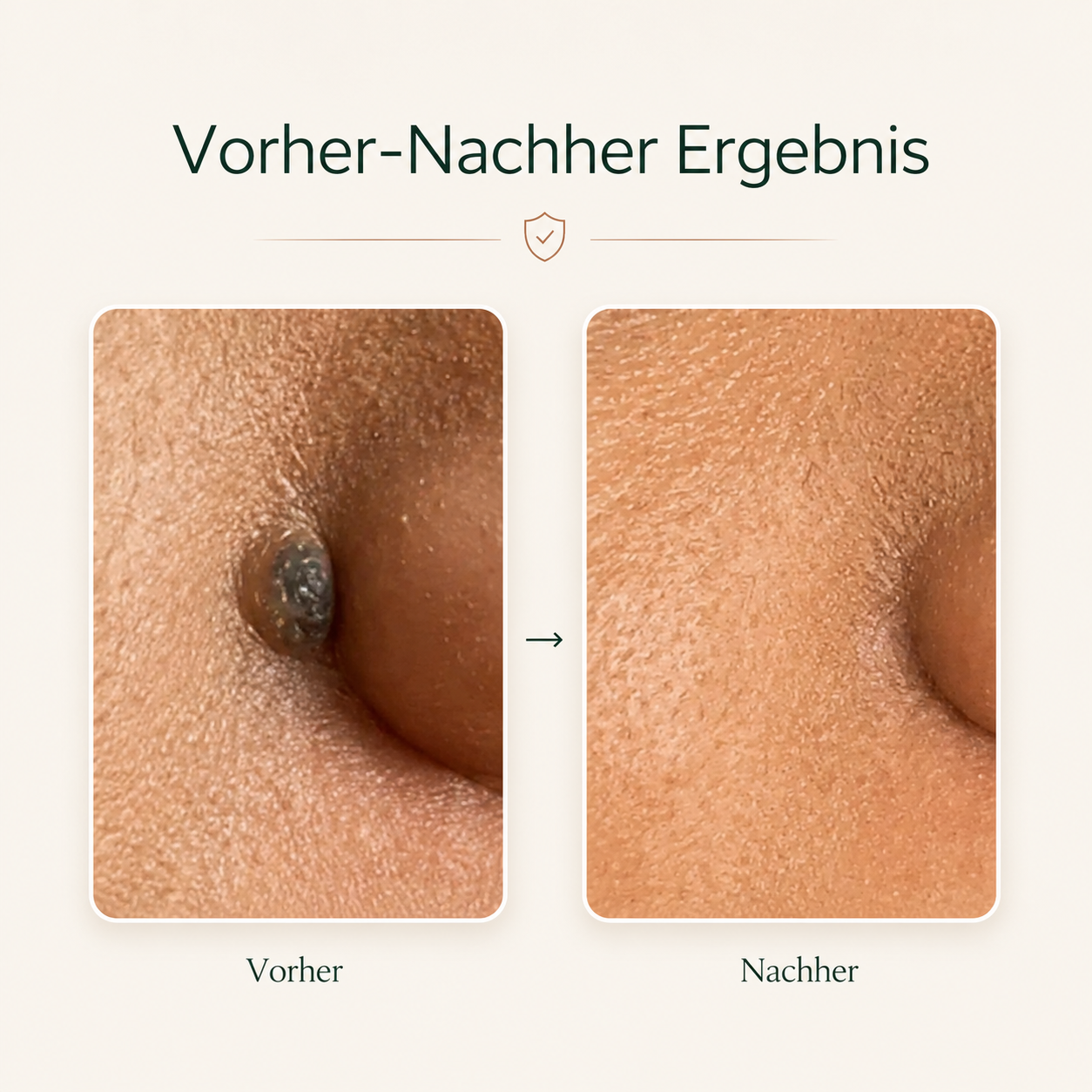 Vorher-Nachher-Creamole